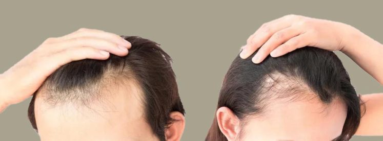 balding